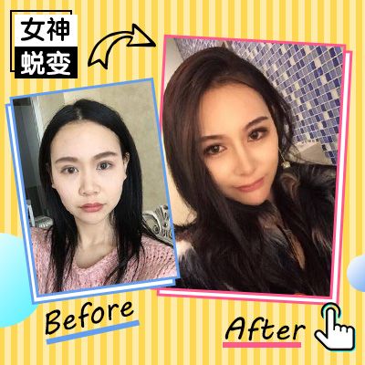 隆鼻大约需要多少钱