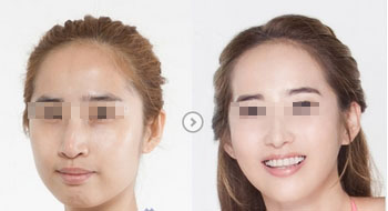 自体隆胸费用详解